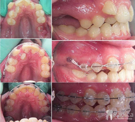 thumbsortodontski mikroimplantati 4 1767739649379 271341473